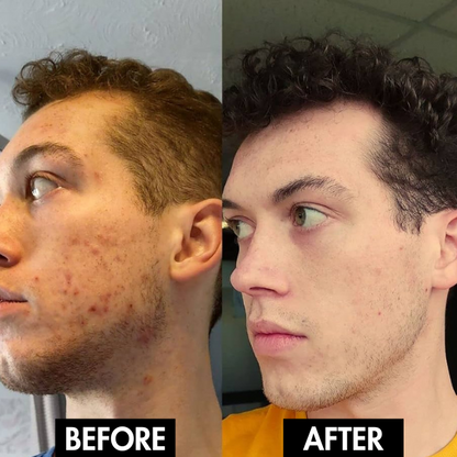 PureGlow Pore Vacuum™