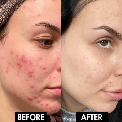 PureGlow Pore Vacuum™