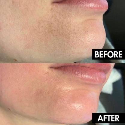 PureGlow Pore Vacuum™